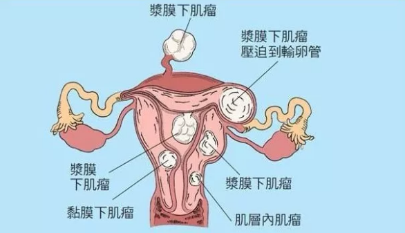 宜昌鑫家圆妇产医院：子宫肌瘤的影响有多大？ 